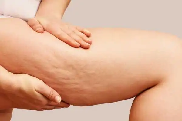 Image of woman showing leg with cellulite Ruislip