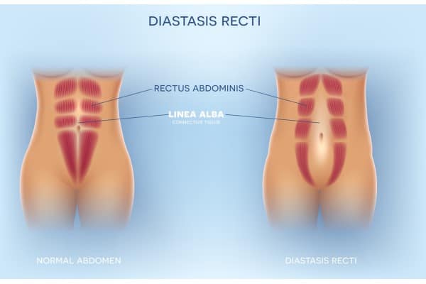 What Non-Surgical Options Are Available for Diastasis Recti Ruislip?