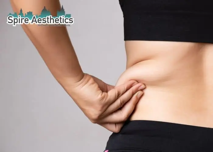 Image of woman pinching fat on their hips Ruislip. Fat Freezing treatment