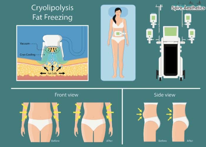 Image of diet and fat freezing combined for best results for Spire Aesthetics Ruislip