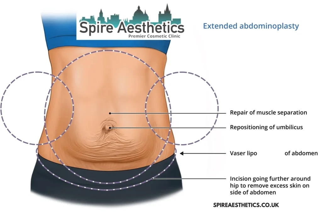 Understanding Loose Skin After Gastric Band Ruislip Surgery and HIFU Treatment