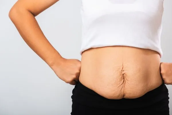 Image of a woman's stomach after weight loss with sagging skin following a gastric band Ruislip