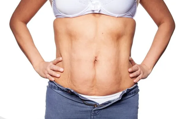 sagging skin on woman's stomach after weight loss injections Ruislip