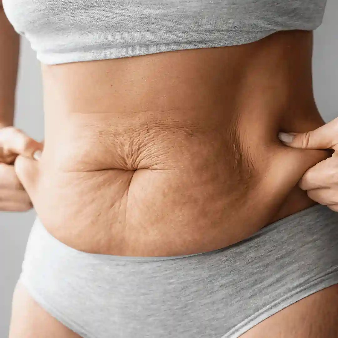 Is It Normal to Have Loose Skin After Pregnancy Ruislip?