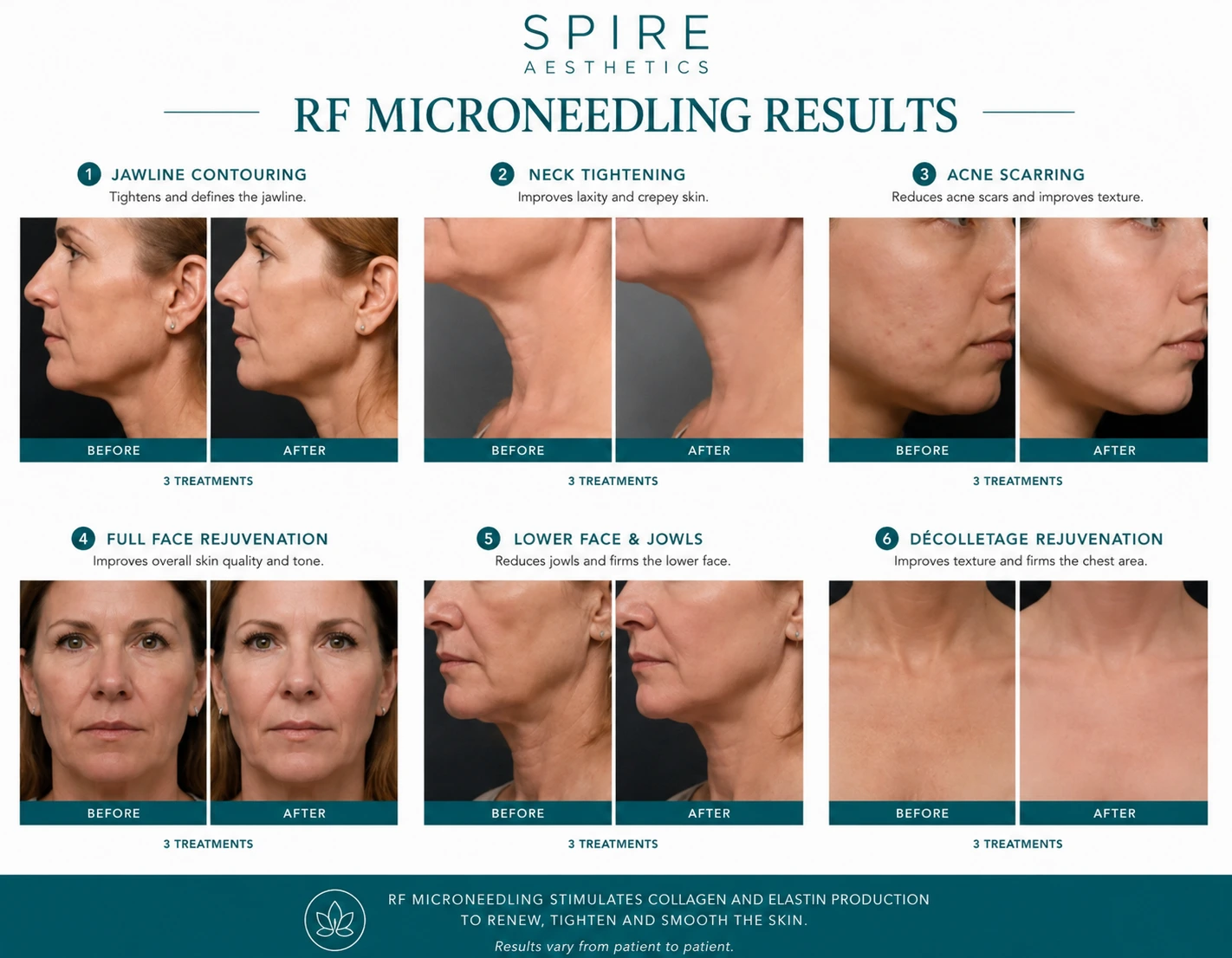 RF Microneedling Skin tightening Ruislip results