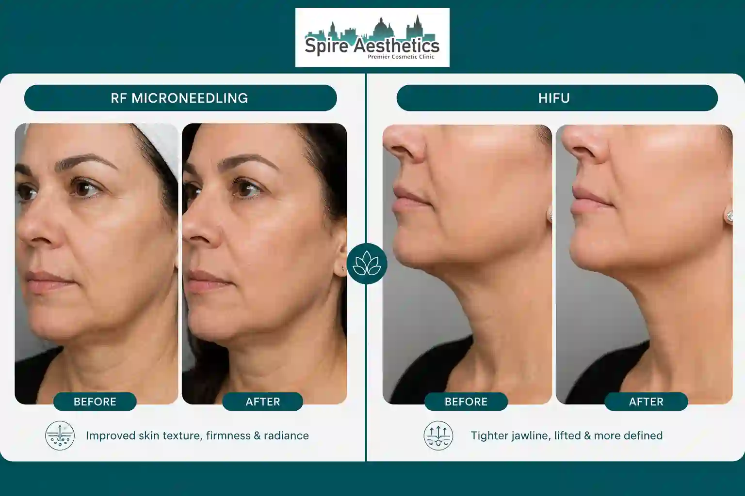 Can RF Microneedling and HIFU Be Combined Ruislip?