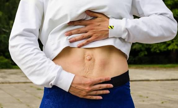 When Could Diastasis Recti Be the Missing Piece of the Puzzle Ruislip?