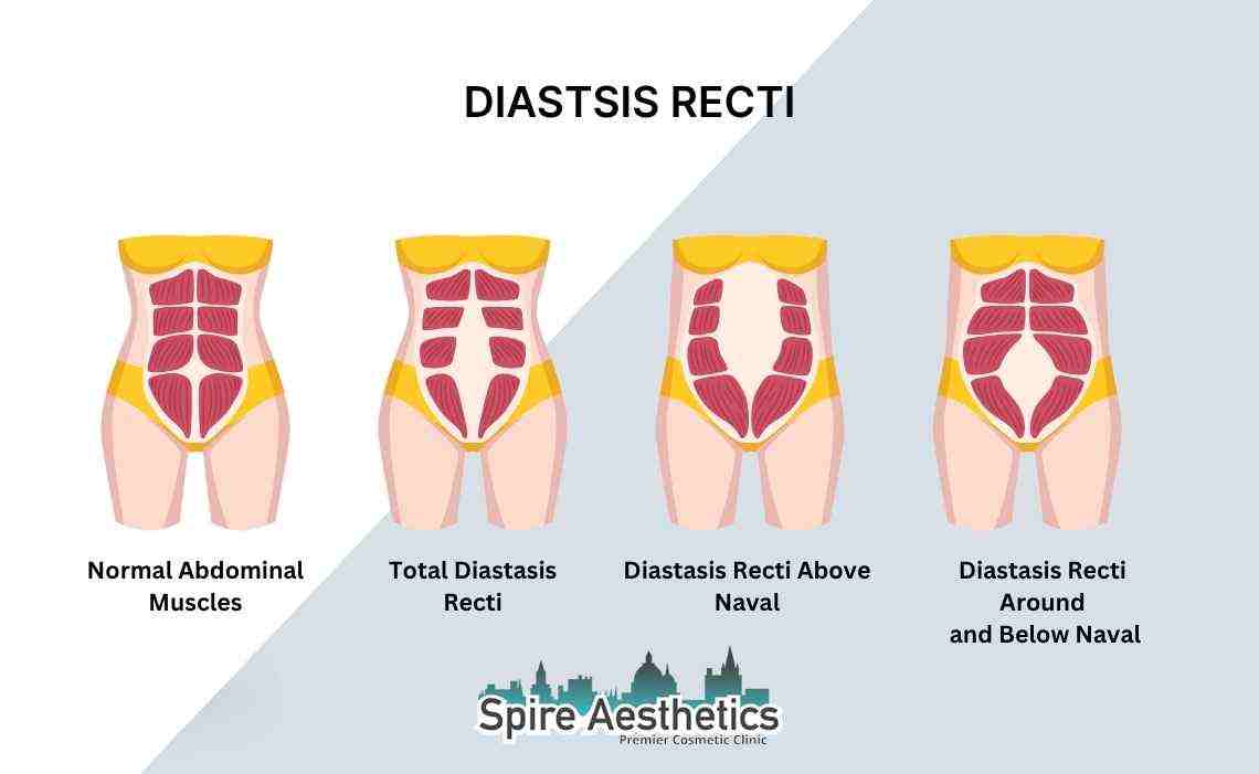 Is Non-Surgical Diastasis Recti Treatment Right for You? Common Concerns Answered Ruislip